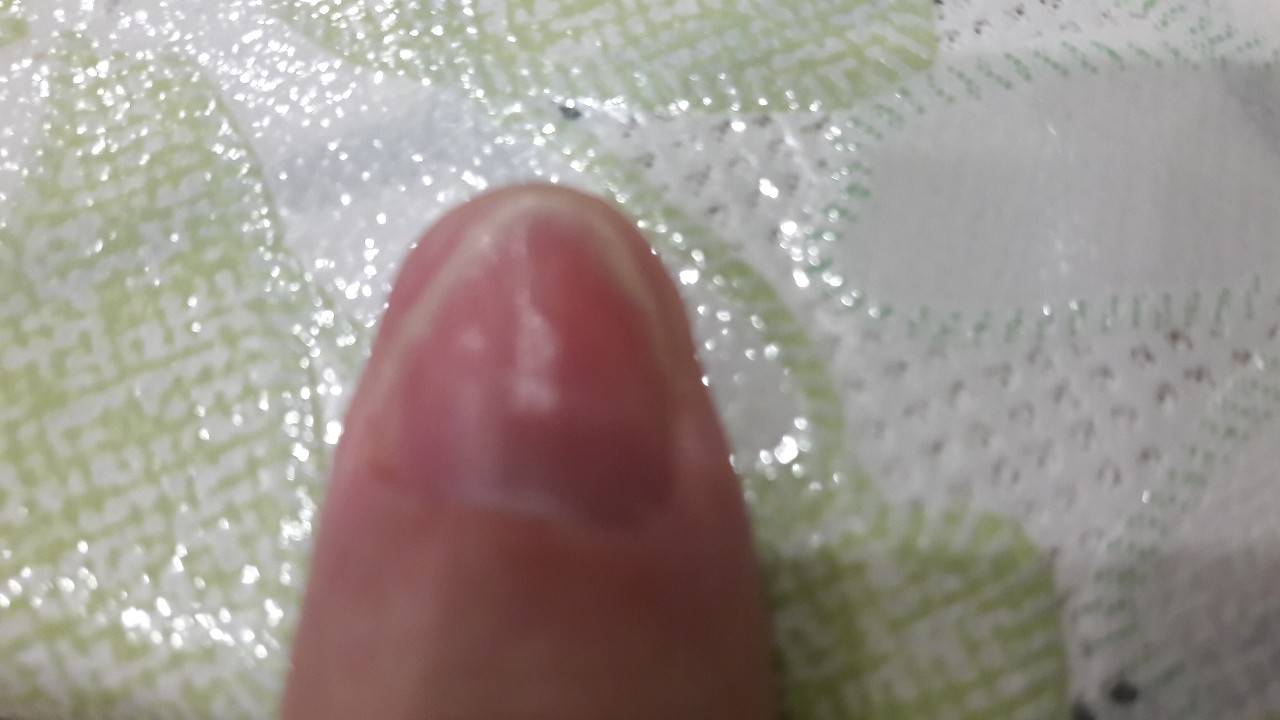 Онихолизис: почему отслаивается ноготь?