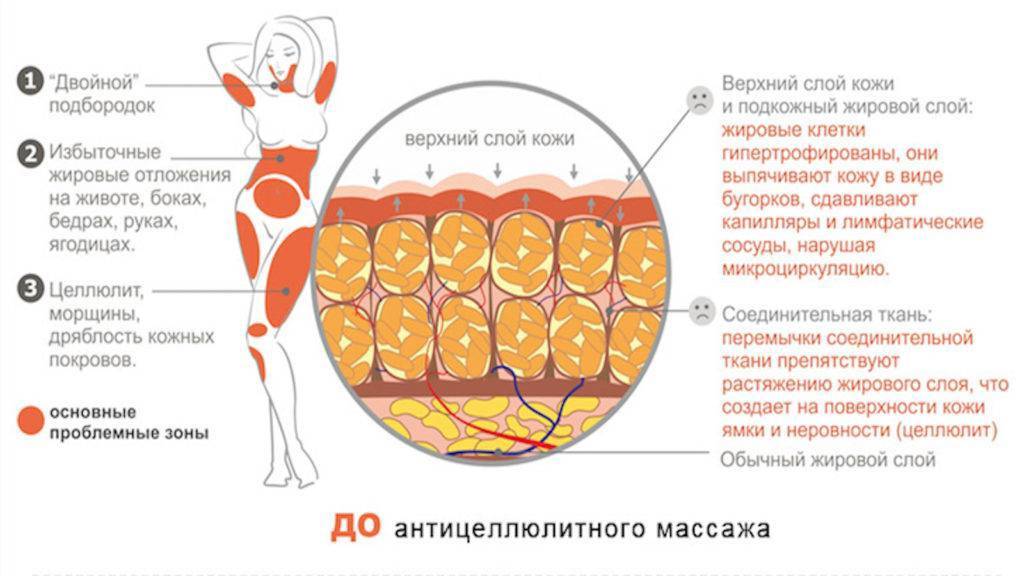 Как избавиться от целлюлита