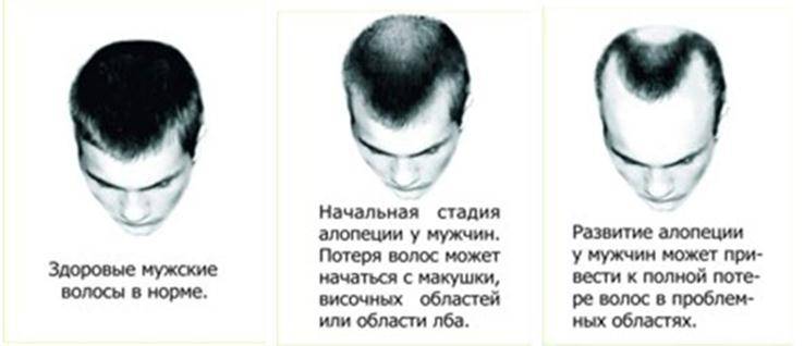 Алопеция: причины, типы выпадения волос, анализы, методы лечения
