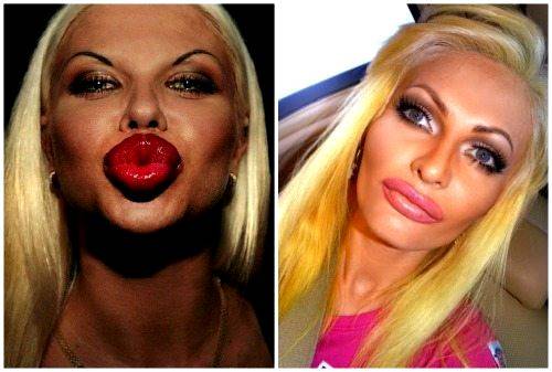 Контурная пластика губ — все подробности процедуры, фото до и после - idealplastic.ru