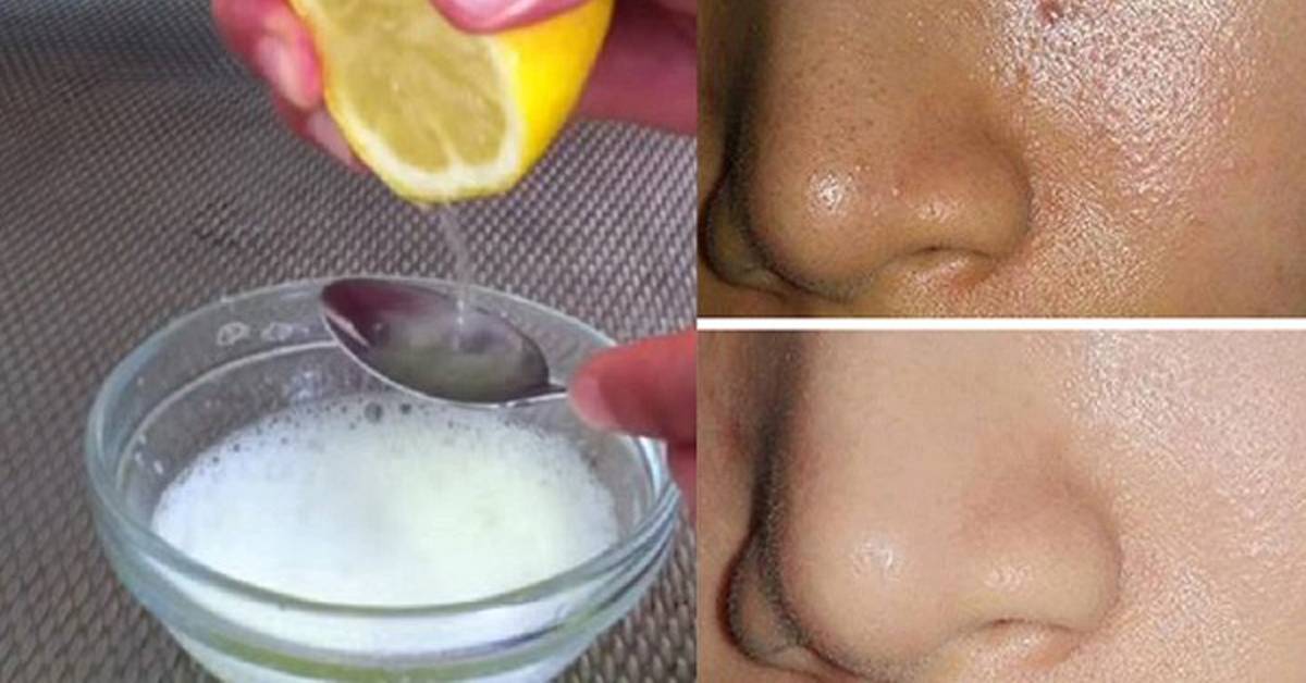 Домашние маски для сужения расширенных пор на лице