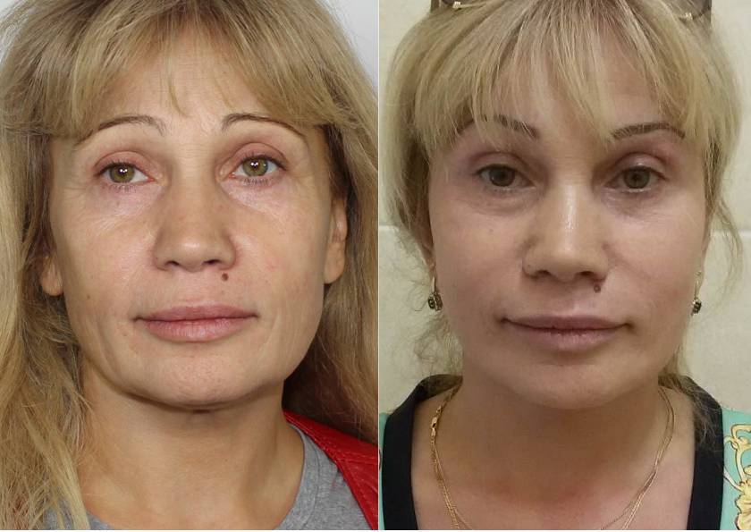 Популярные пластические операции на лице
