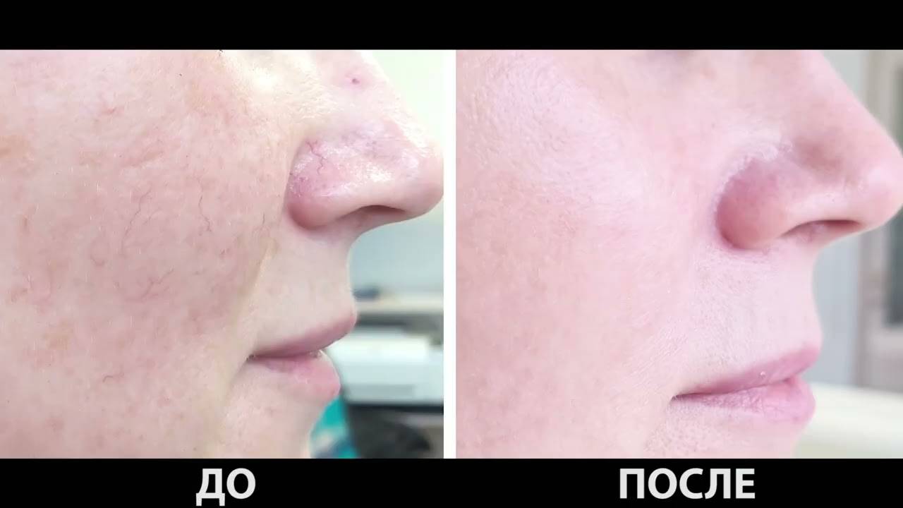 Лечение купероза в домашних условиях - народные средства от купероза