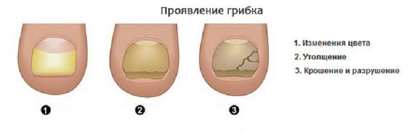 Лечение утолщенного ногтя на ногах. причины и лечения толстого ногтя на ногах. обзор немецких средств.