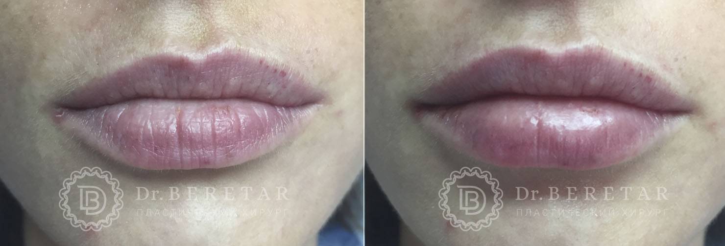 Стоит ли увеличивать губы: плюсы, минусы, нюансы | плюсы и минусы