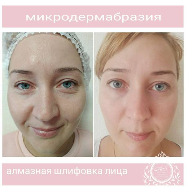 Алмазная шлифовка лица в салоне и дома