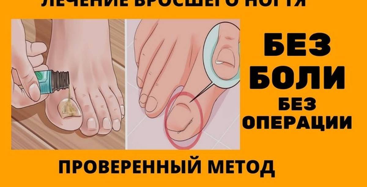 Как избавиться от вросших ногтей