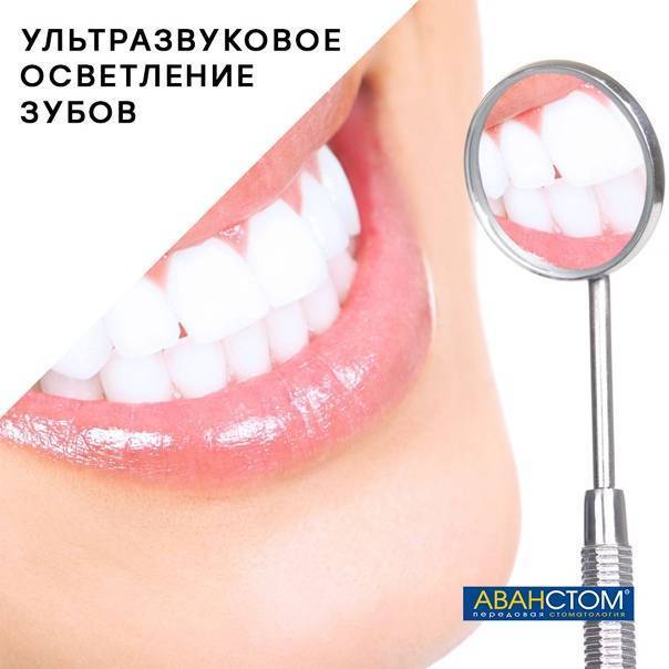 Отбеливание зубов капами – санкт-петербург dental house