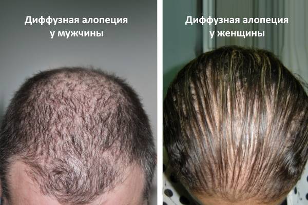 ▷ диффузная алопеция: причины и лечение - clinicana
