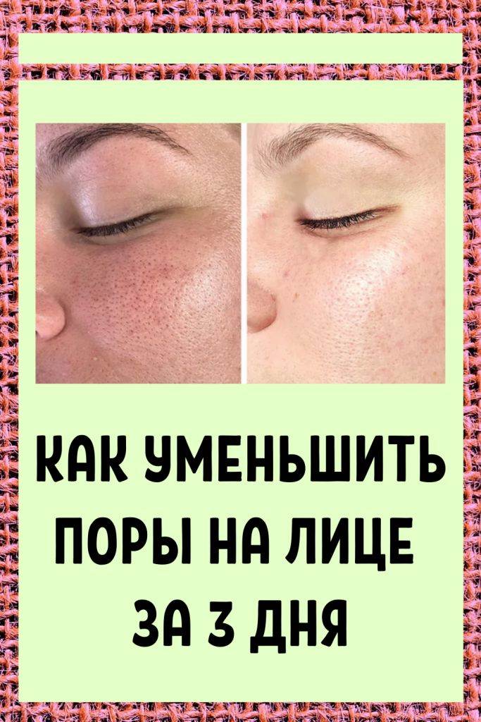 Как сузить поры на лице в домашних условиях быстро и эффективно: советы
как сузить поры на лице — модная дама