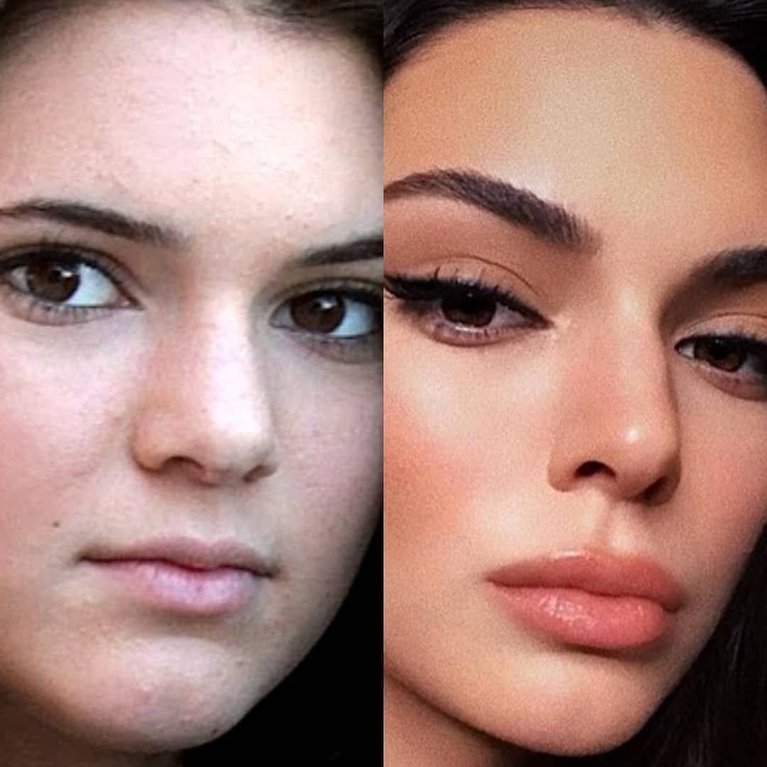 Kendall jenner plastic surgery journey - vanity