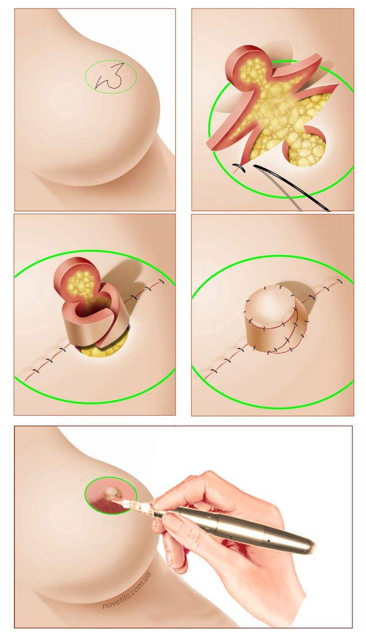 Что такое коррекция сосков и ареолы, показания, противопоказания