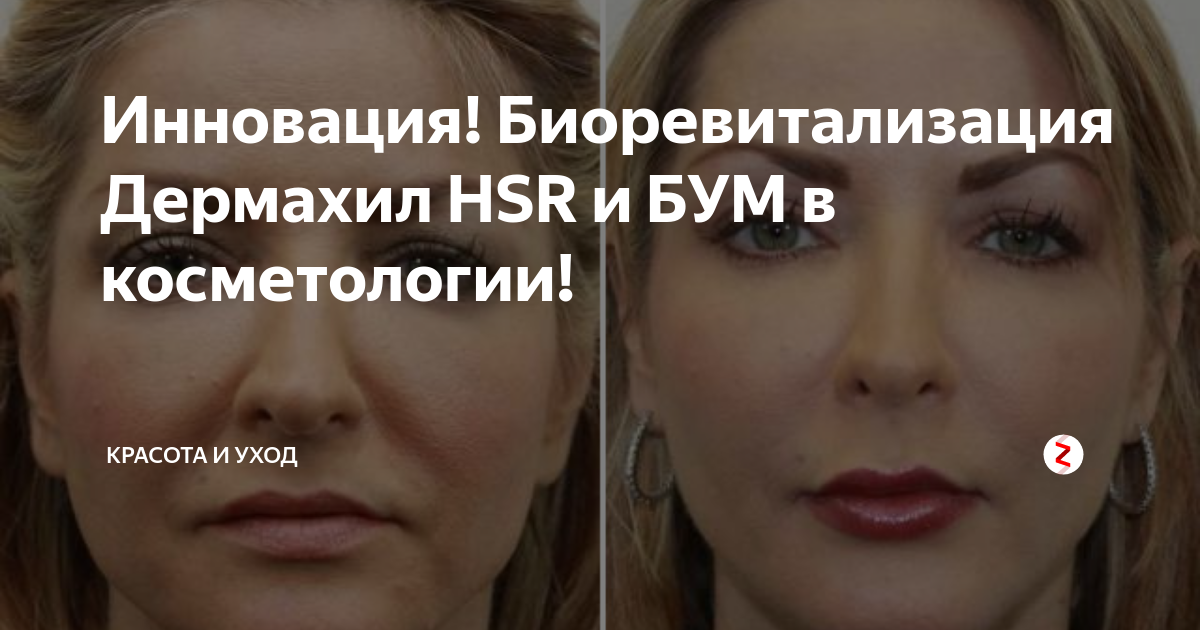 Дермахил от мешков под глазами в мезотерапии hsr. отзывы косметологов