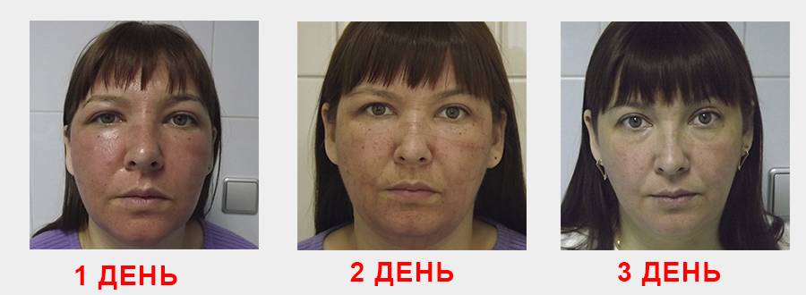 Показания и противопоказания к проведению  плазмолифтинга