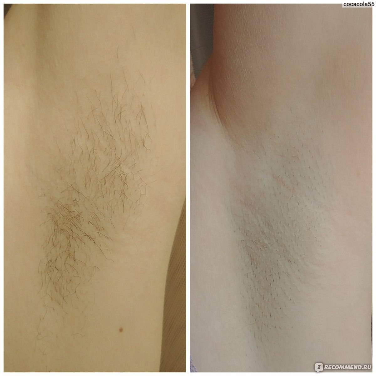 Влияние различных способов удаления волос на кожу в подмышке - unibeauty.ru