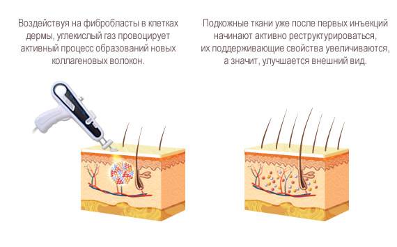 Уколы карбокситерапии или безинъекционная карбокситерапия?