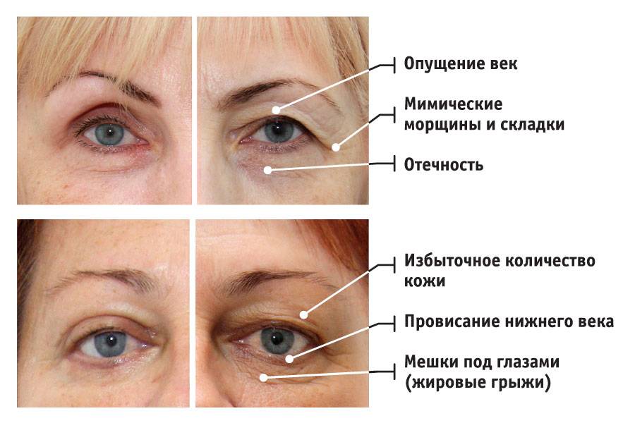 После ботокса мешки под глазами и отеки: как убрать и что делать