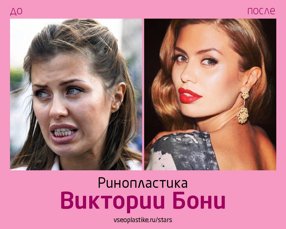 Виктория боня до и после пластики. виктория боня пластические операции - ресницамания