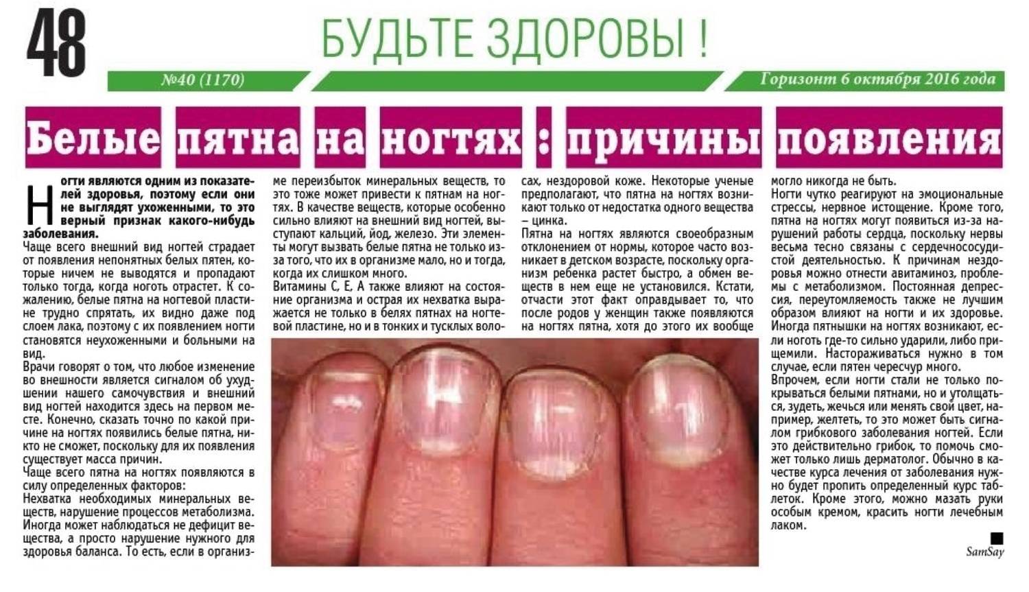 Причины появления белых пятен на ногтях