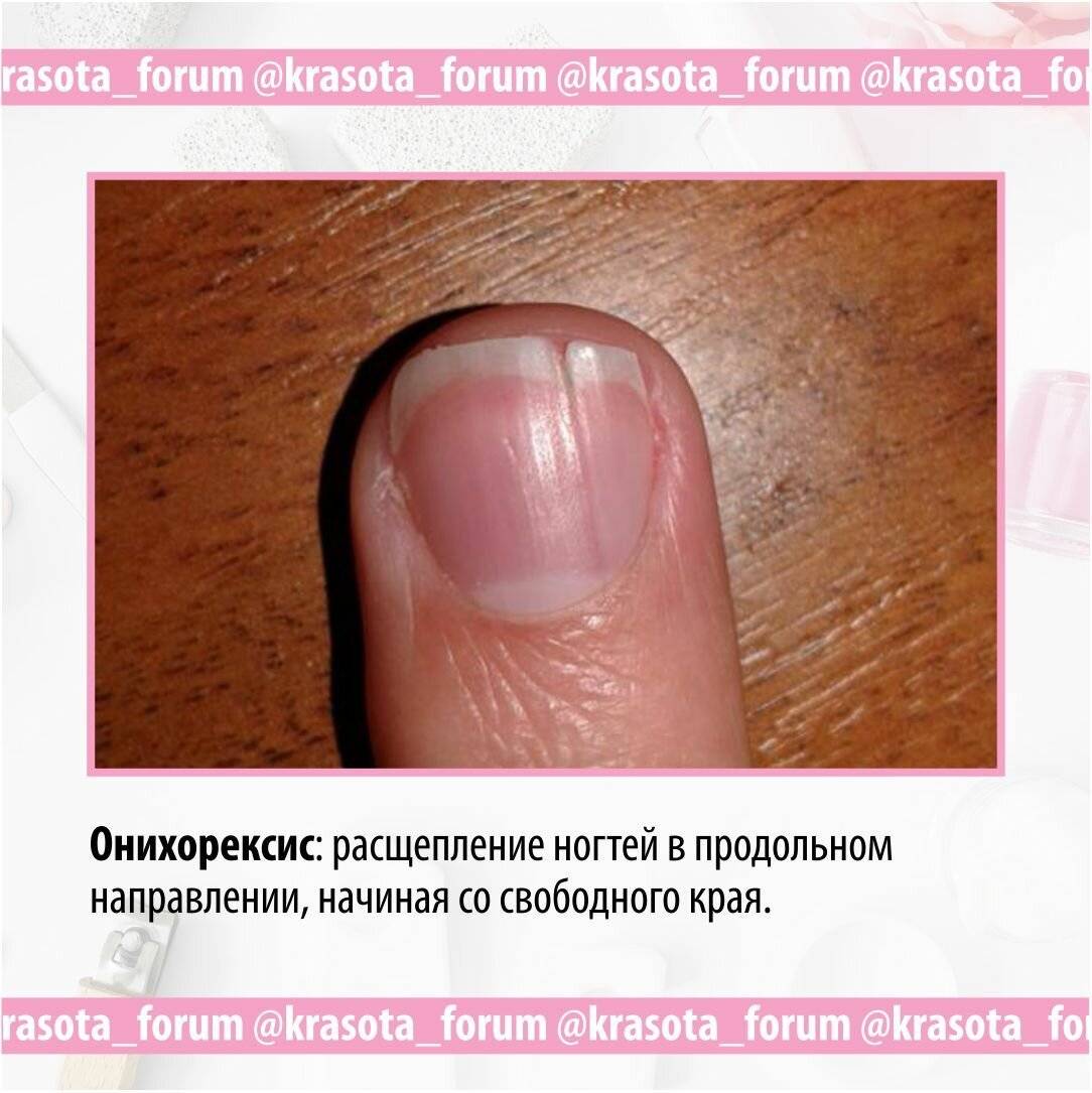 Слоящиеся ногти: причины, способы устранить расслаивание