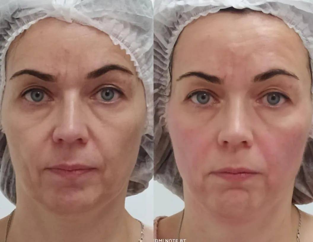 Ultherapy (альтера-терапия) отзывы