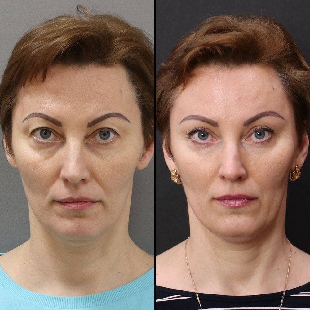 Эндоскопическая подтяжка лица. преимущества эндопластики.