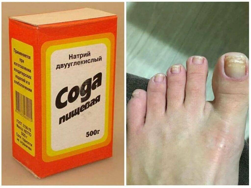 Удаление ногтя на ноге при грибке: лазерное, аппаратное и хирургическое удаление