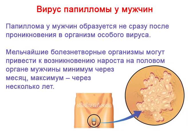 Папилломы на теле. причины появления. как избавиться?