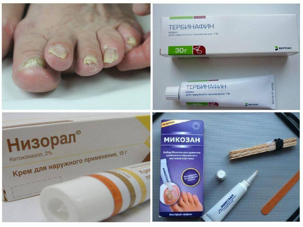 Как распознать и лечить начальную стадию грибка на руках и ногах