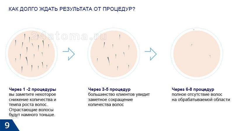 Лазерная эпиляция