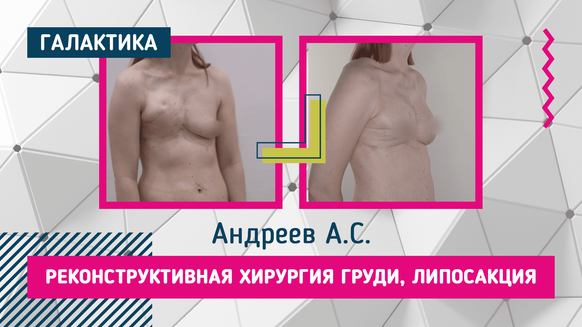 Подтяжка груди без имплантов