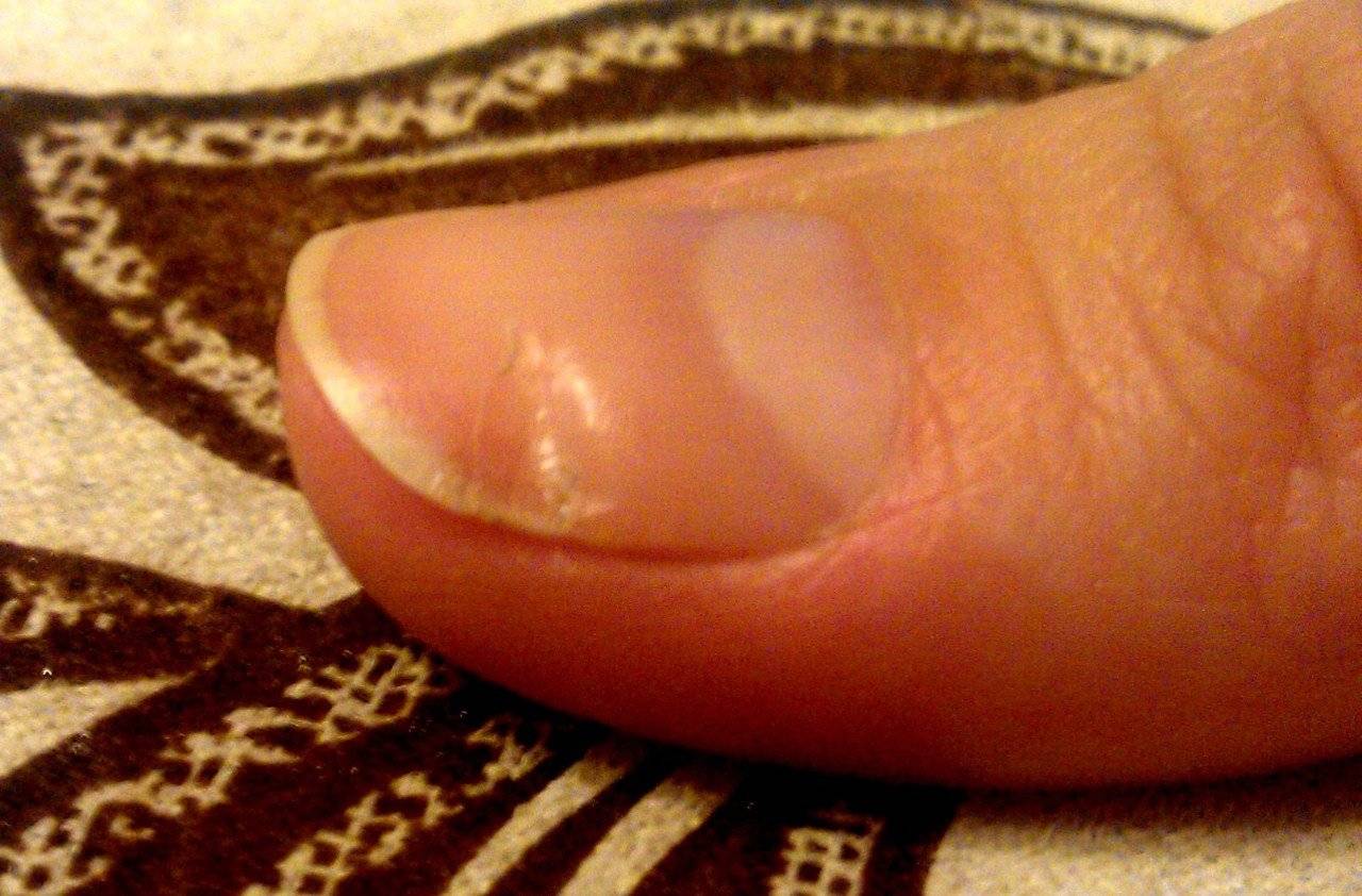 Ребристые ногти на руках и ногах: причины, методы лечения