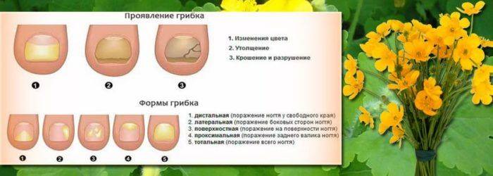Как использовать масло чистотела от грибка ногтей на ногах?