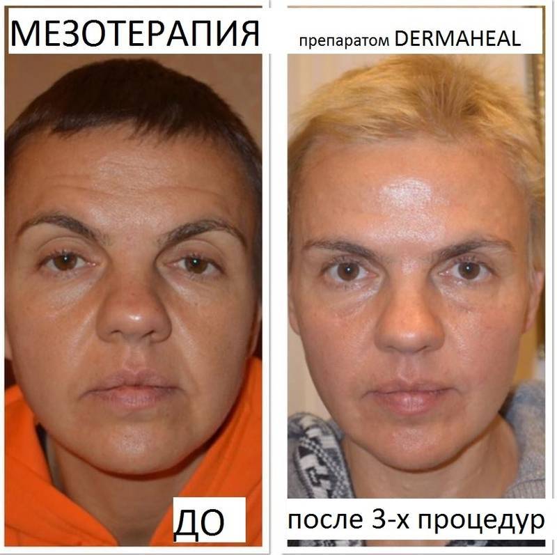 Дермахил от мешков под глазами и темных кругов: отзывы косметологов и простых пользователей