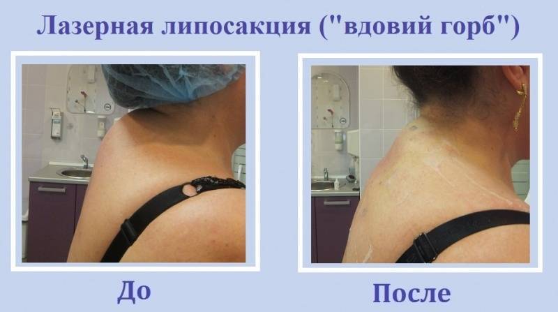 Лазерный липолиз: обзор аппарата slimus, фото до и после, клинические исследования | портал 1nep.ru