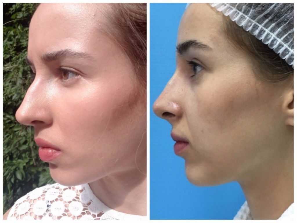 Безоперационная ринопластика: методики, советы, фото, отзывы