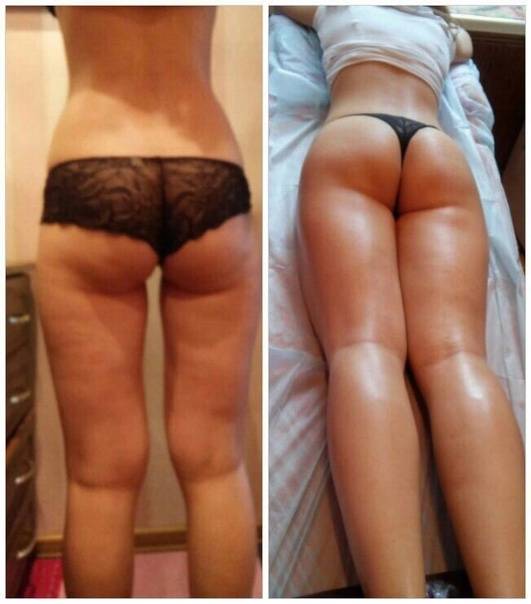 Как убрать складку под 🍑 ягодицами? [инструкция]