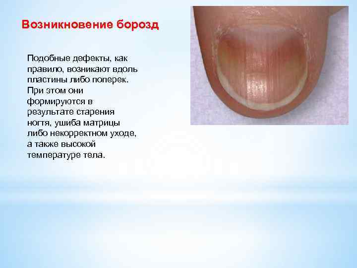 Ониходистрофия