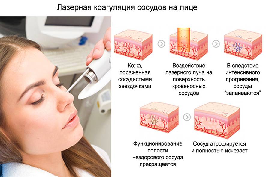 Причины и лечение купероза на лице