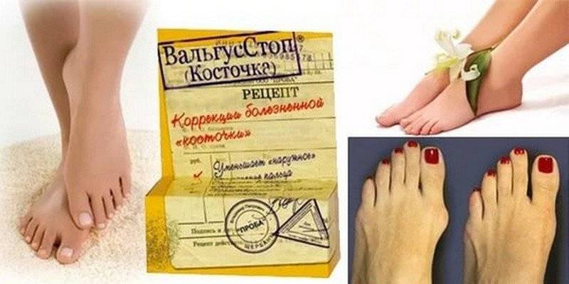 ✅ ортопедический фиксатор valgus pro отзывы - таласса.рф