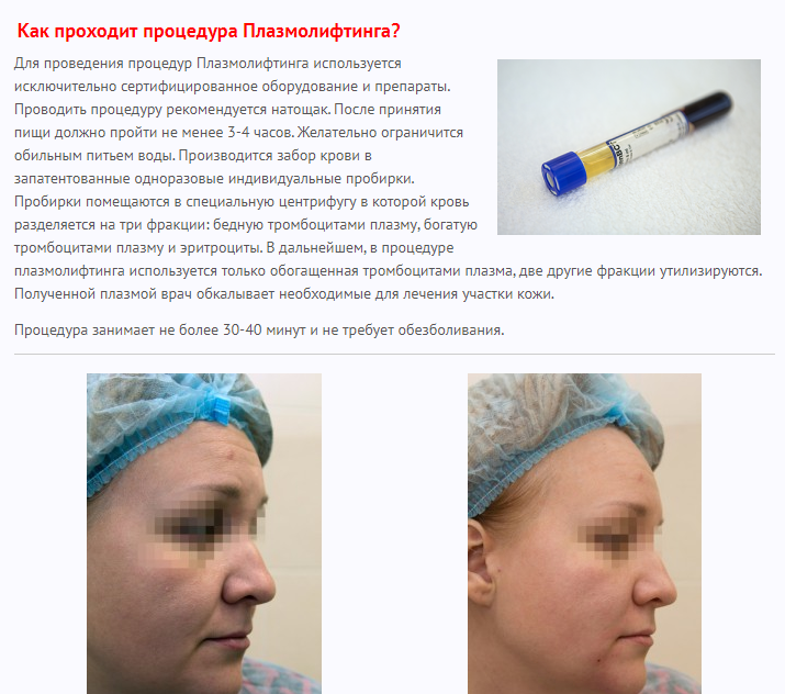 Плазмолифтинг — что это? все об особенностях процедуры, показания и противопоказания | обзоры салона красоты «эпатаж»