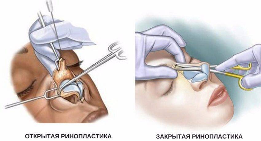 Нос не ломают, а разбирают. 8 фактов о ринопластике | flacon