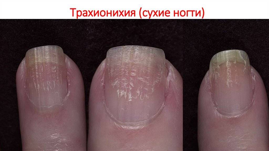 Болезни ногтей: причины, симптомы и лечение - «ваш доктор» - ваш медицинский журнал