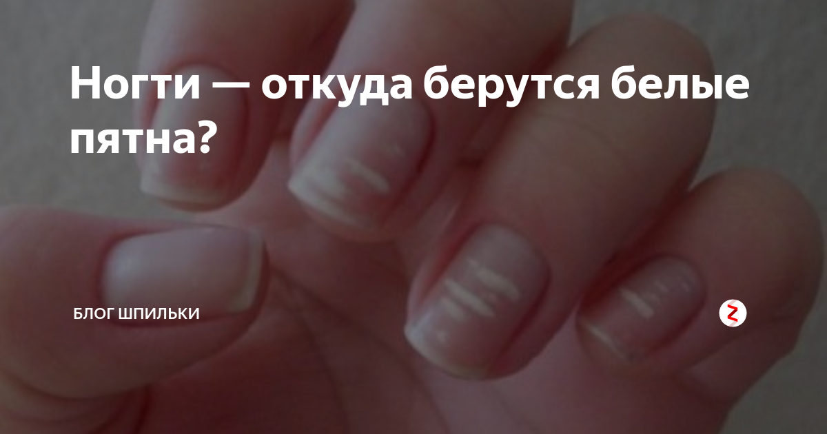 Белые пятна на ногтях у ребенка и взрослого: причины