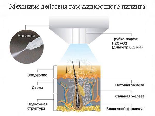 Газожидкостный пилинг