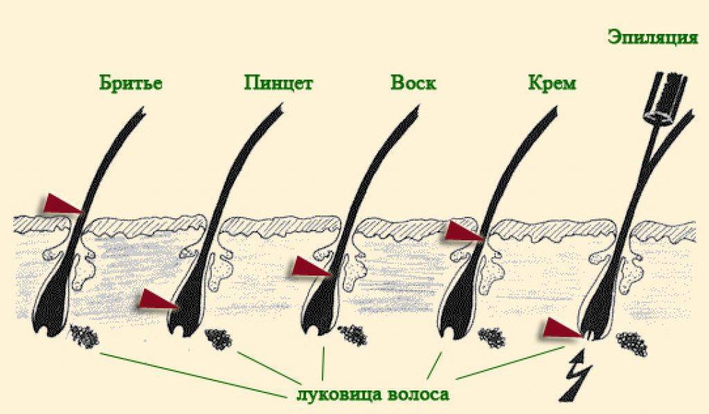 Удаление волос в ушах