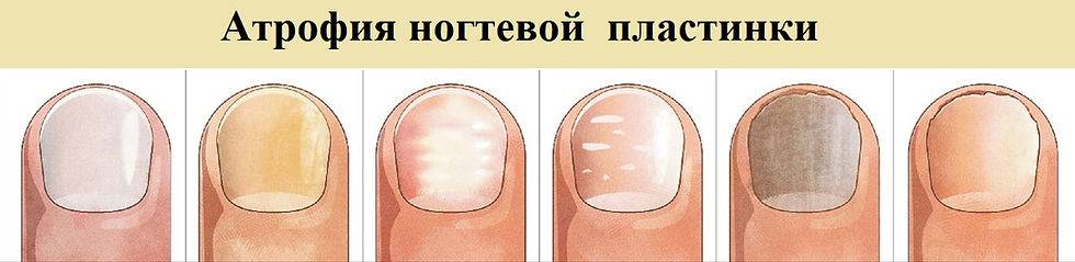 Какое средство эффективнее всего от бороздок на ногтях?