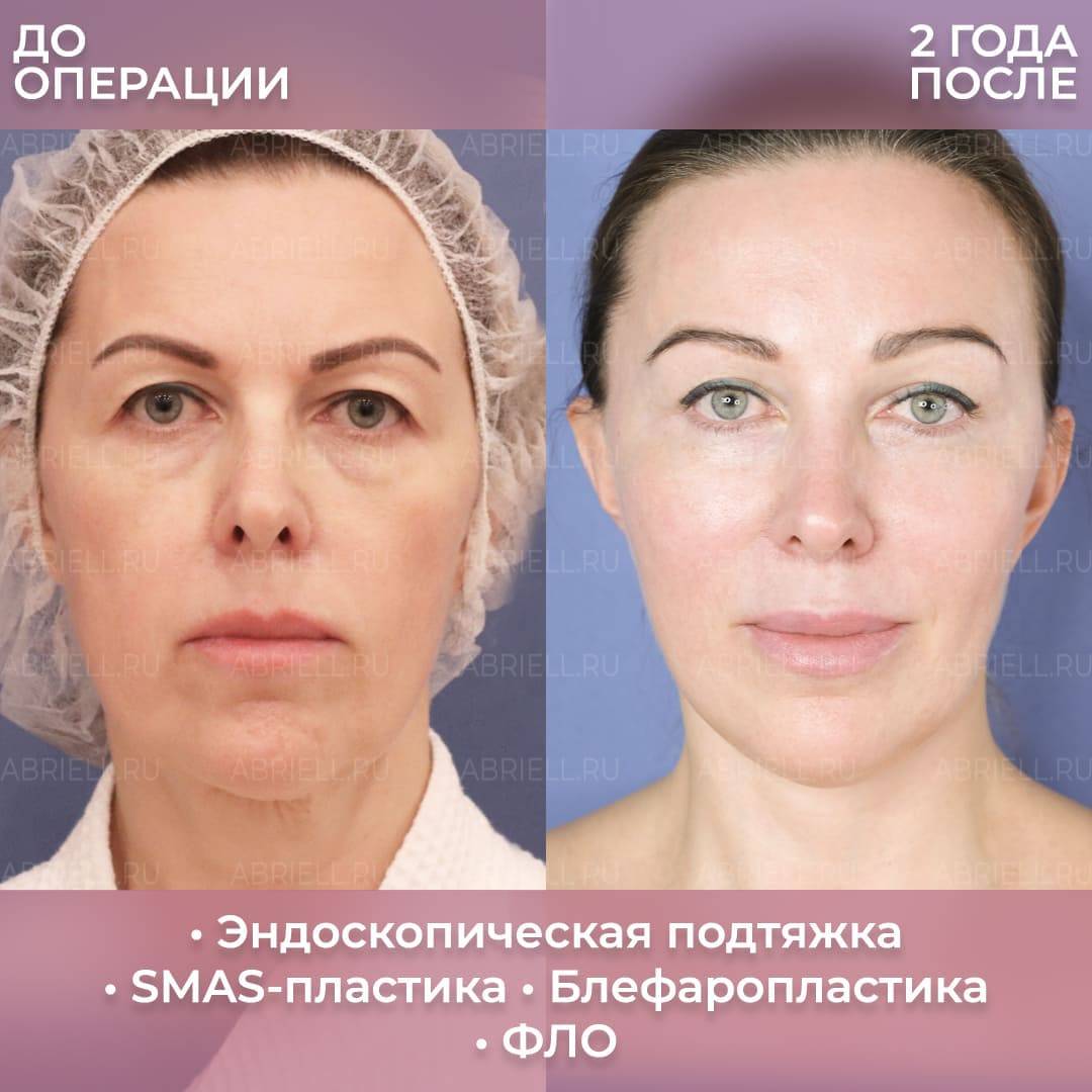 Эндоскопическая подтяжка лба и бровей: что это такое, как делается