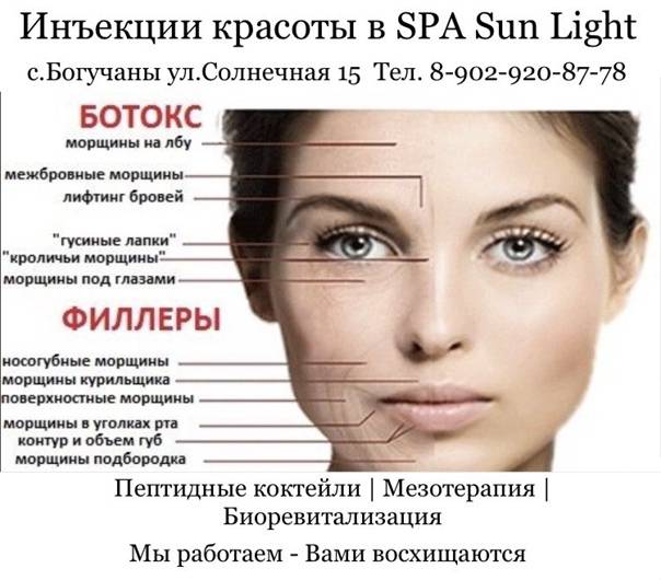 Сколько единиц «ботокса» нужно на лоб и межбровье