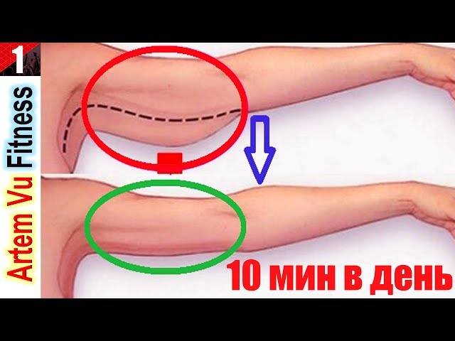 Подтяжка тела, армирование нитями aptos. внутренняя сторона рук и плеч